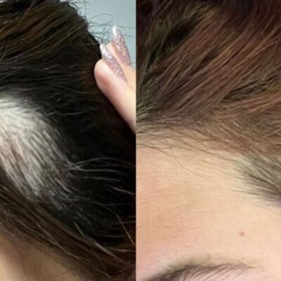 Thinning hair stopped shedding ‘almost instantly’ with growth serum