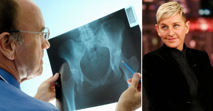 What is osteoporosis? Ellen DeGeneres was diagnosed with this bone condition