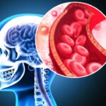 Stanford develops milli-spinner device for more effective stroke treatment