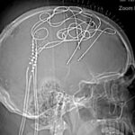 Dr. Sanjay Gupta on the mysteries of chronic pain