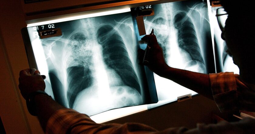 Maine reports 3 active TB cases, world’s deadliest infectious disease