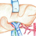 Transplanter à l’envers le foie d’un donneur aux organes en miroir