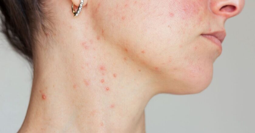 People with Rosacea urged to make simple indoor change