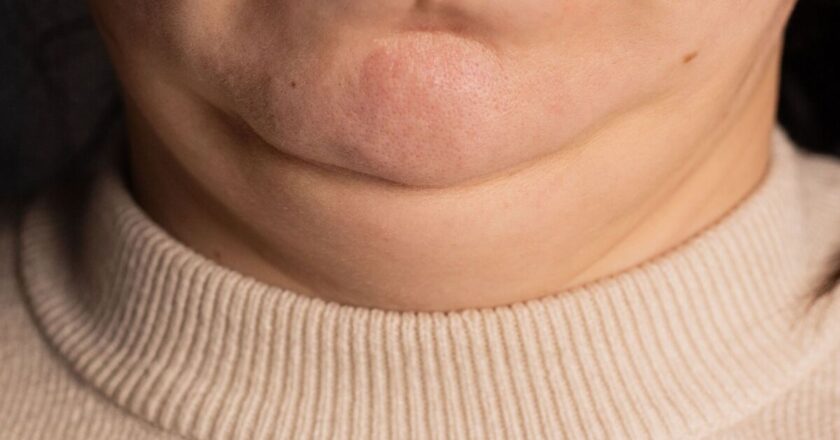 1 simple exercise will &lsquo;get rid of double chin&rsquo; – says chiropractor