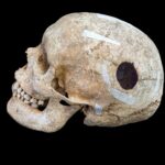 Evidence of world’s first surgery found on Viking-age man’s skull